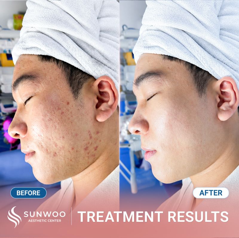 Acne treatment before and after at Sunwoo