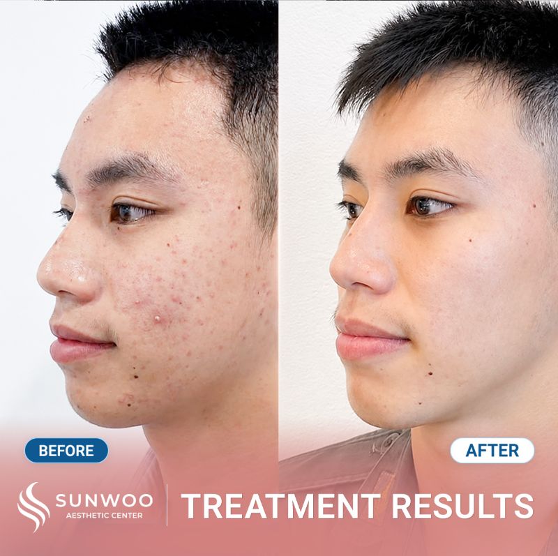 Acne treatment before and after at Sunwoo