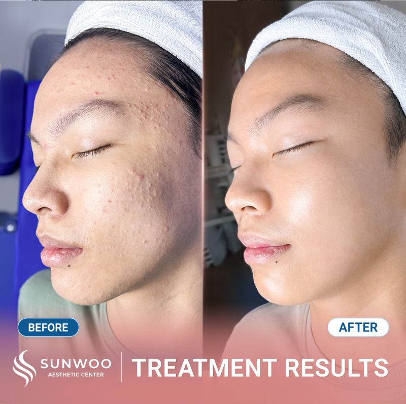 Acne treatment before and after at Sunwoo