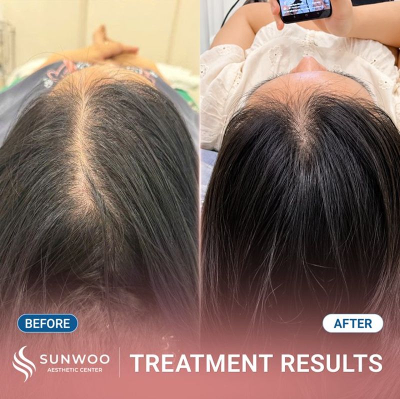 Meso Hair Therapy before and after at Sunwoo