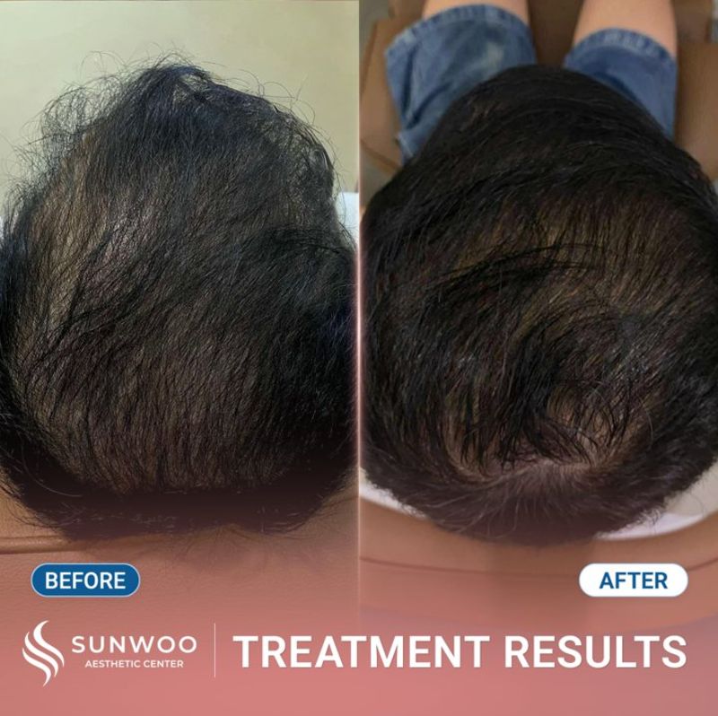 Meso Hair Therapy before and after at Sunwoo