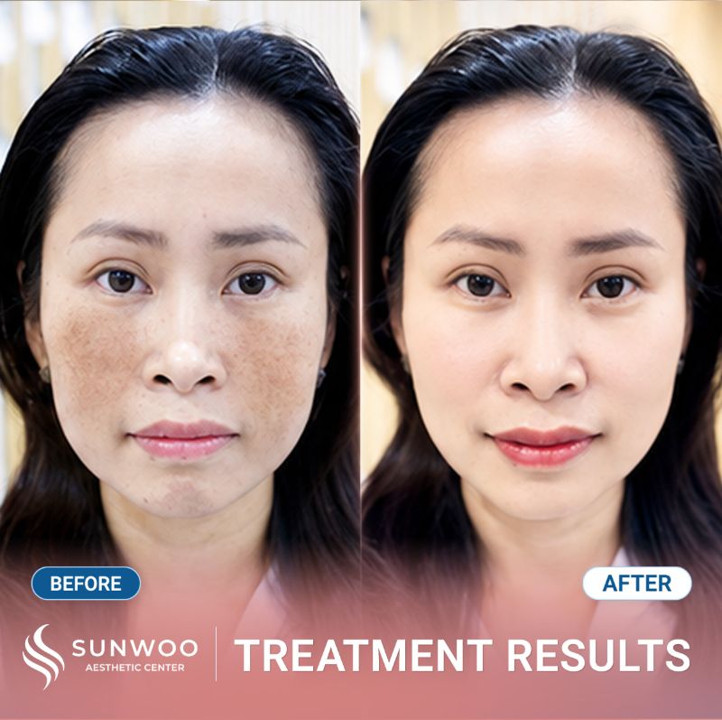PicoSure Pro before and after at Sunwoo