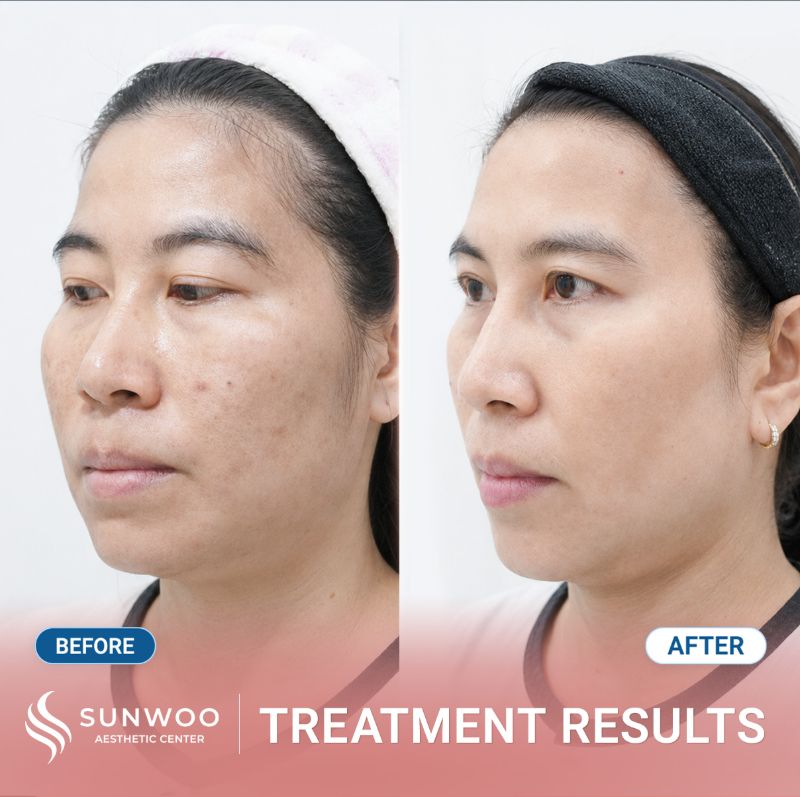 PicoSure Pro before and after at Sunwoo