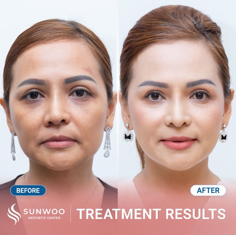 Xline Thread Lift before and after at Sunwoo
