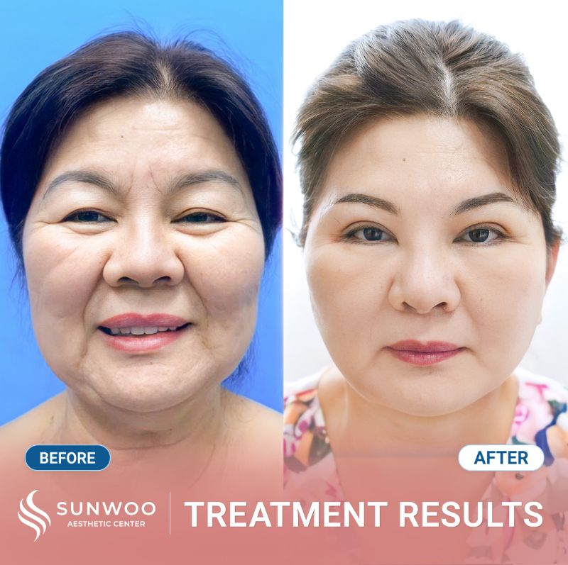 Xline Thread Lift before and after at Sunwoo