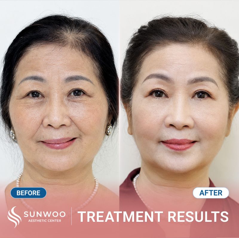 Xline Thread Lift before and after at Sunwoo